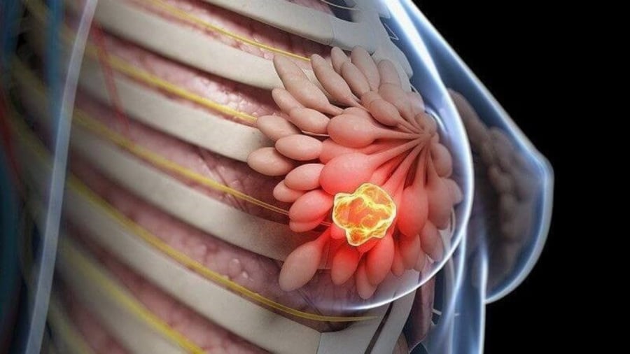 8 kiểu phụ nữ dễ bị K vú nhất: Xem bạn có trong số đó?